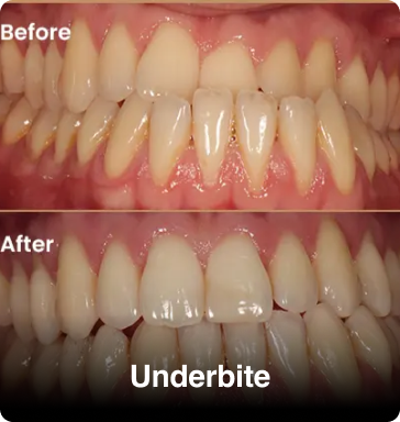 Same-Day-Underbite