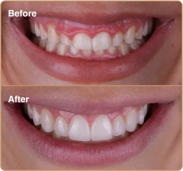 before-after-2
