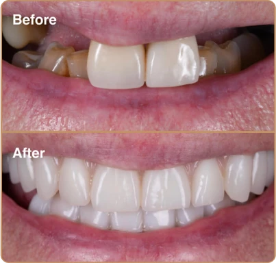 dental-implants-2