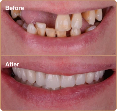 dental-implants-3