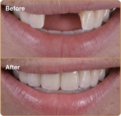 dental-implants-4