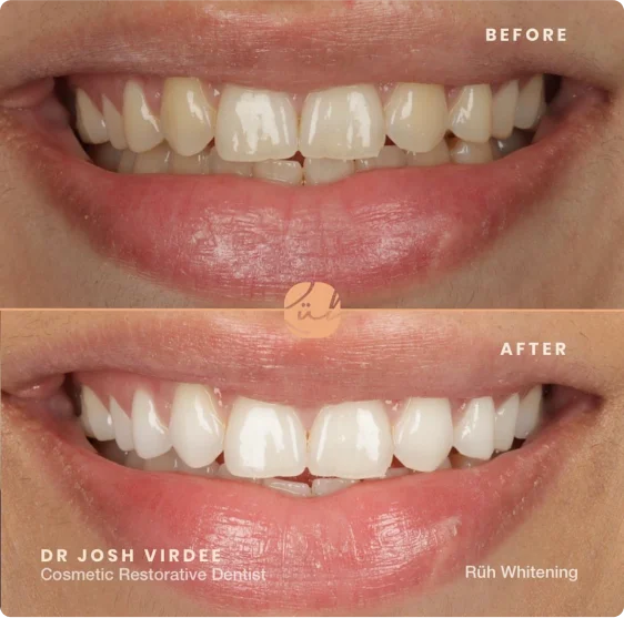 teeth-whitening-1