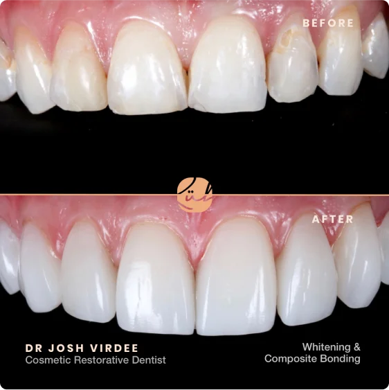 teeth-whitening-2