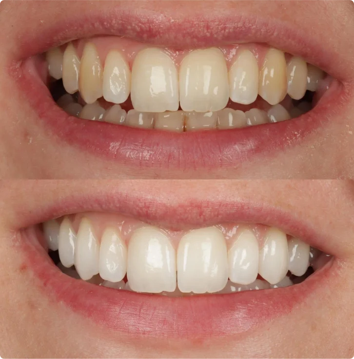 teeth-whitening-3