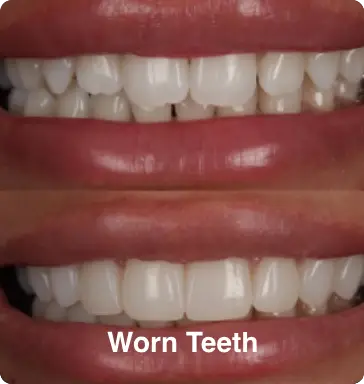 Worn Teeth