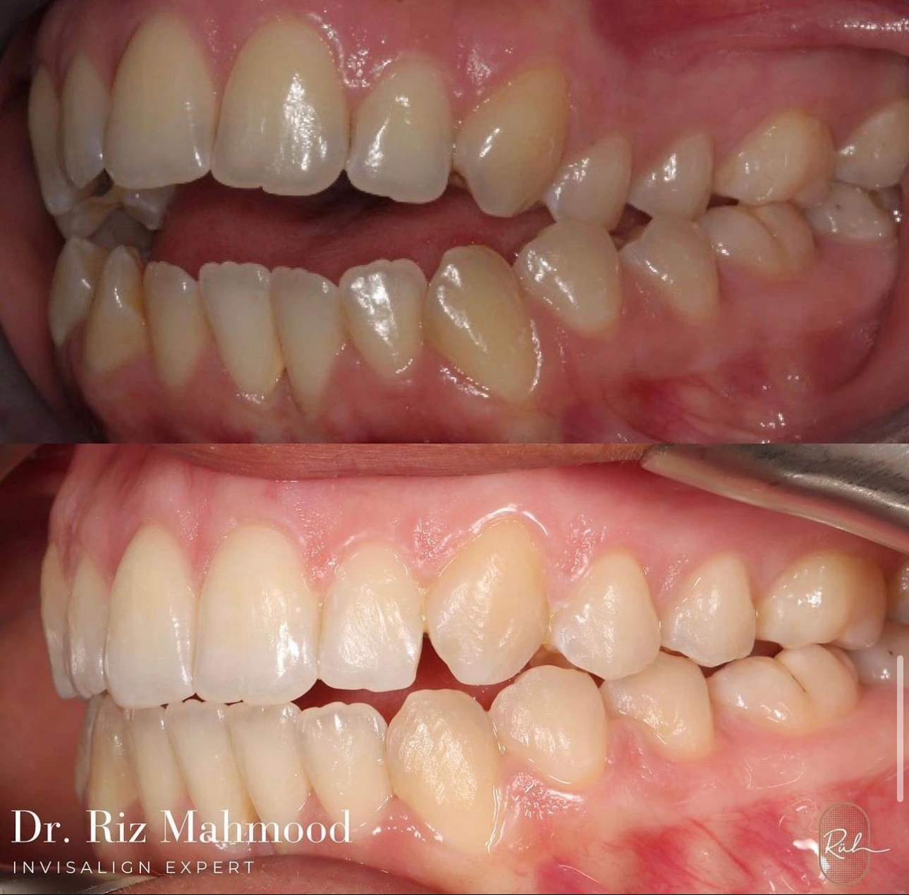 before & after 1