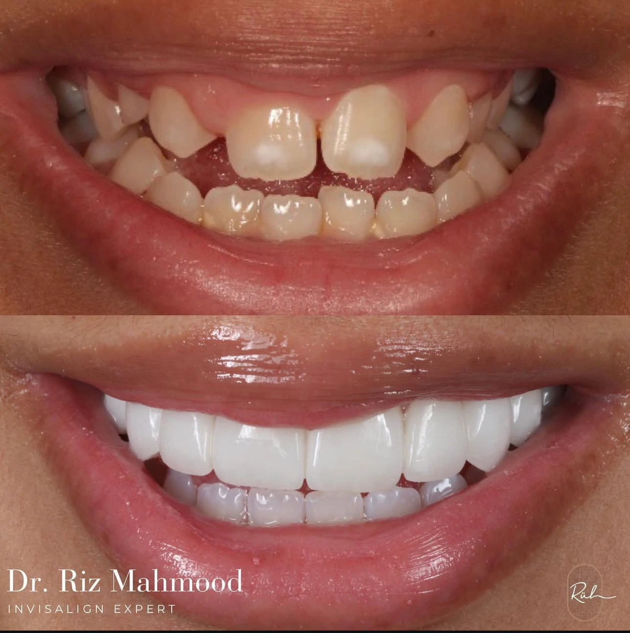 before & after 2