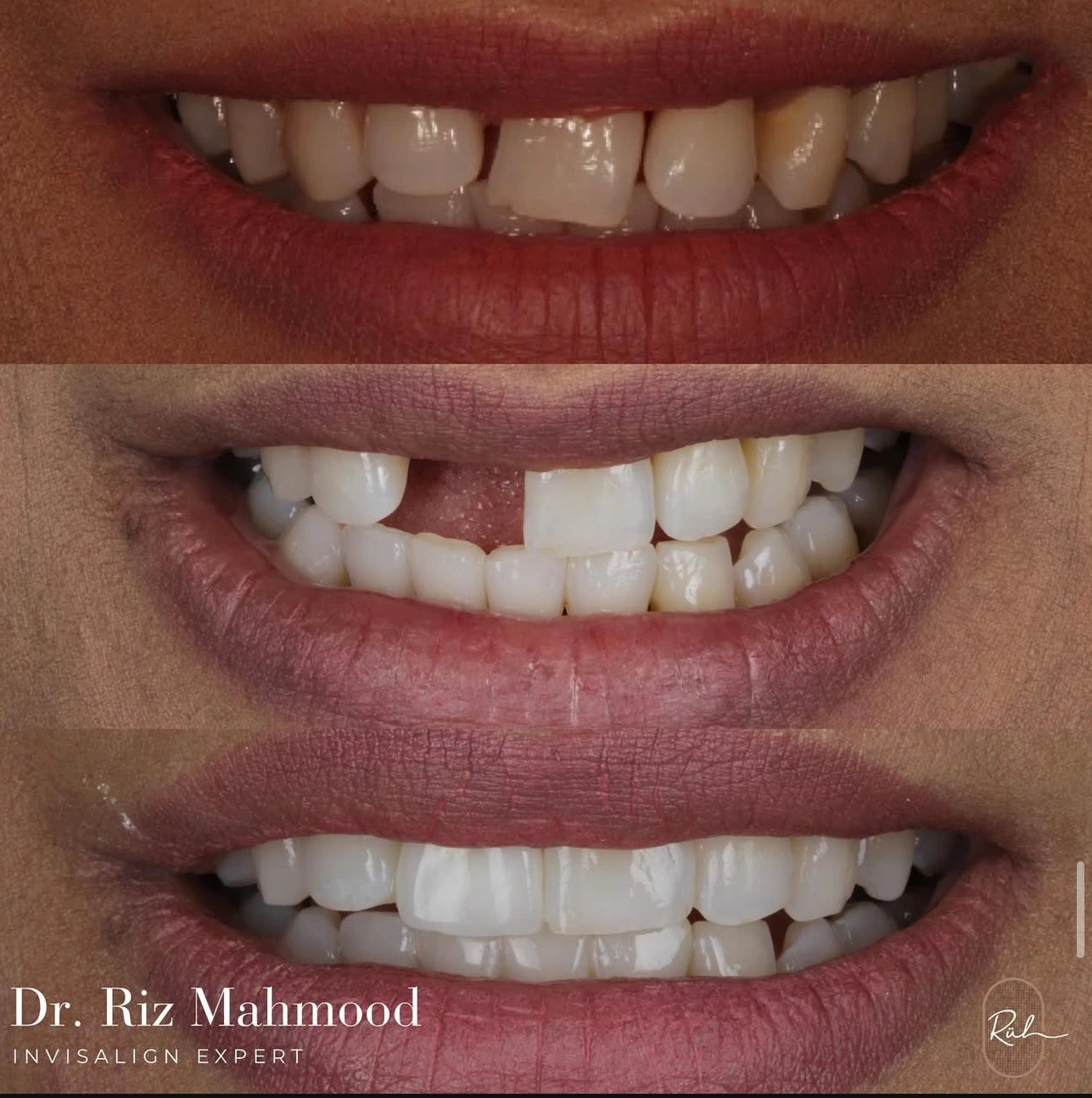 before-after-3