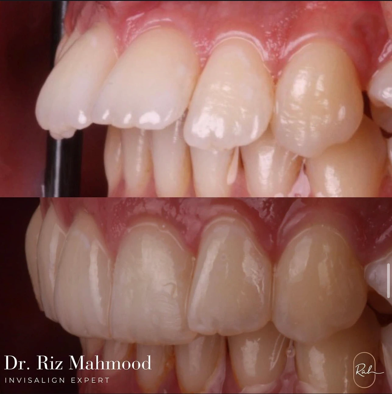 before-after-4