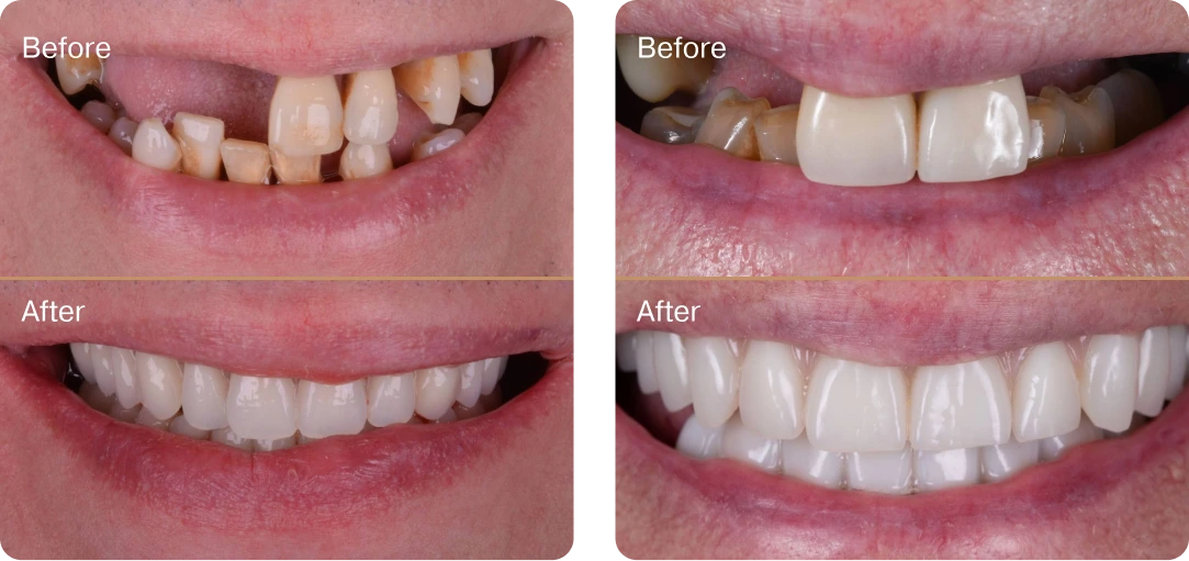 implant-vs-dentures