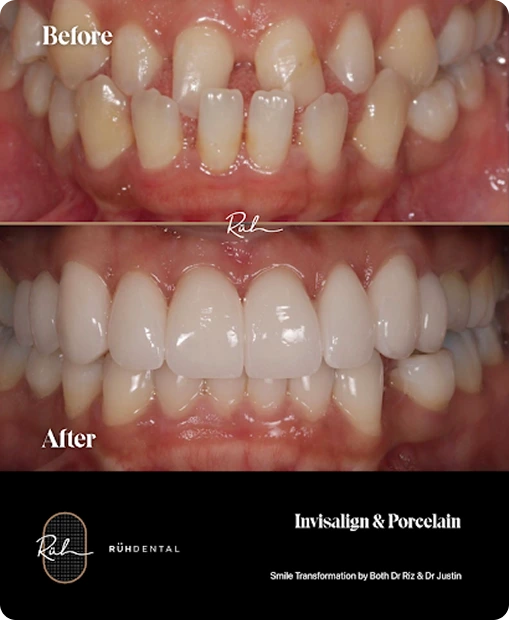 invisalign-porcelain invisalign-porcelain