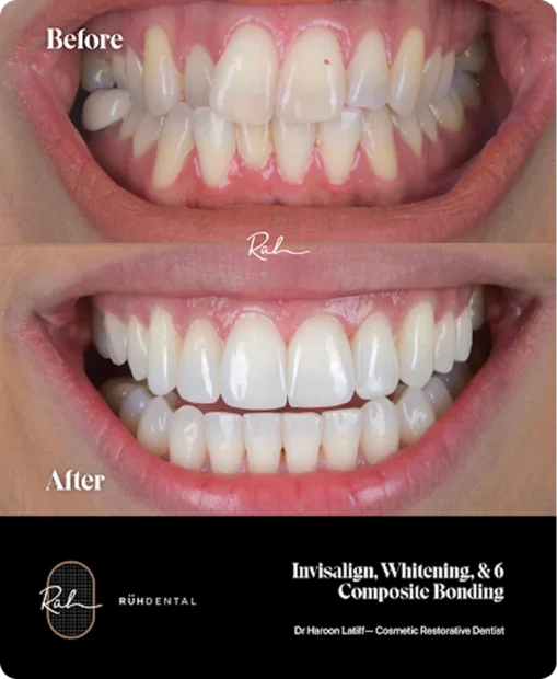 invisalign-whitening-composite-509x620 invisalign-whitening-composite-509x620