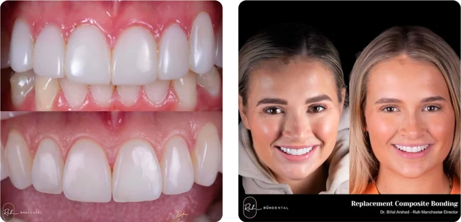 Molly's-composite-bonding Molly's-composite-bonding
