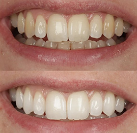 tooths-upd3